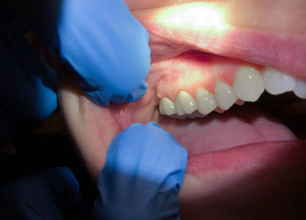 Best Emergency Root Canal Treatment in Ridgecrest, FL
